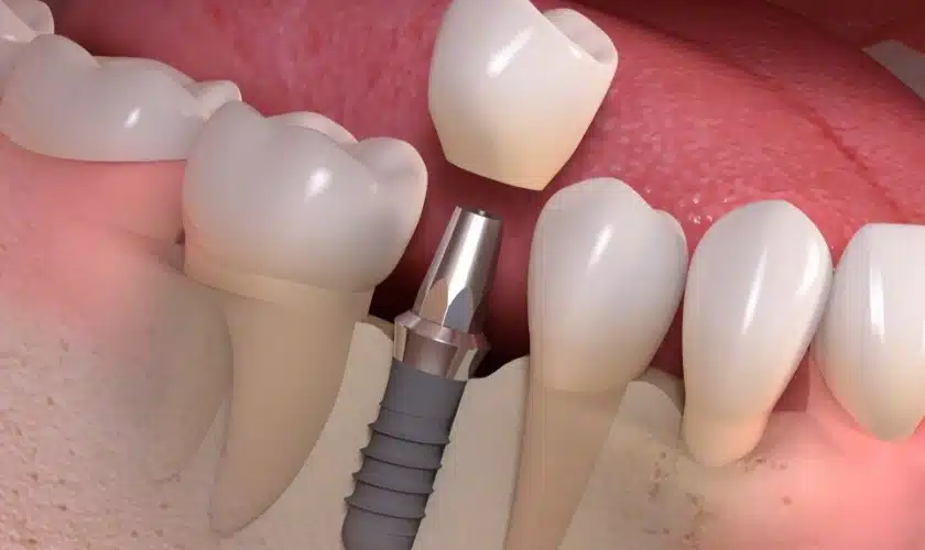 Featured image for “What steps are involved in getting dental implants?”