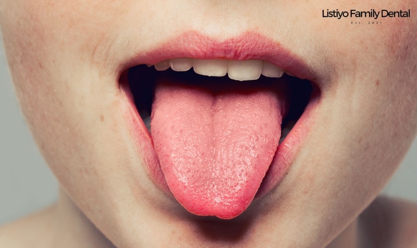 Featured image for “What does spots on your tongue mean?”